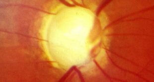 glaucoma